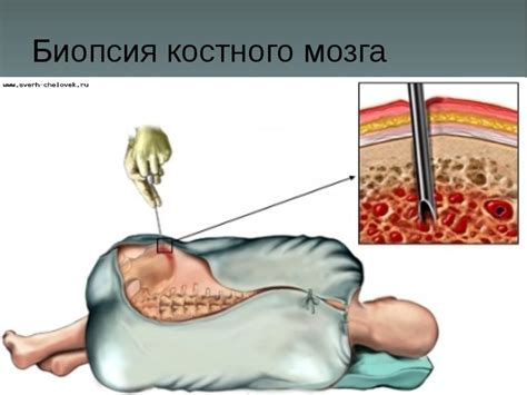 Биопсия костного мозга