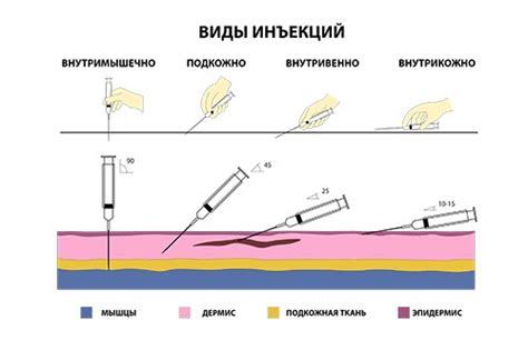 Разные виды инъекций